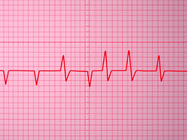 Understanding Right Bundle Branch Block: Key ECG Insights
