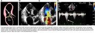 Recognizing Dynamic LVOTO Key To Managing Shock Patients Recognizing Dynamic LVOTO Key To Managing Shock Patients