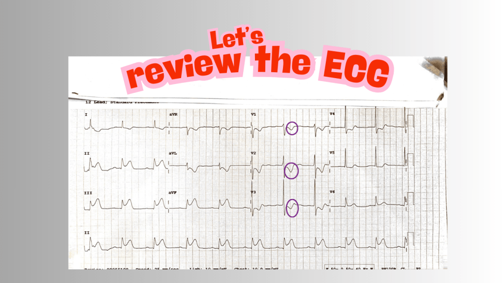 ECG printout showing leads I, II, III, aVR, aVL, aVF, V1 to V6 with annotations highlighting areas of interest.