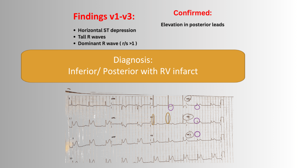 ECG findings for inferior and posterior myocardial infarction showing horizontal ST depression and tall R waves in leads V1-V3, confirming elevation in posterior leads.