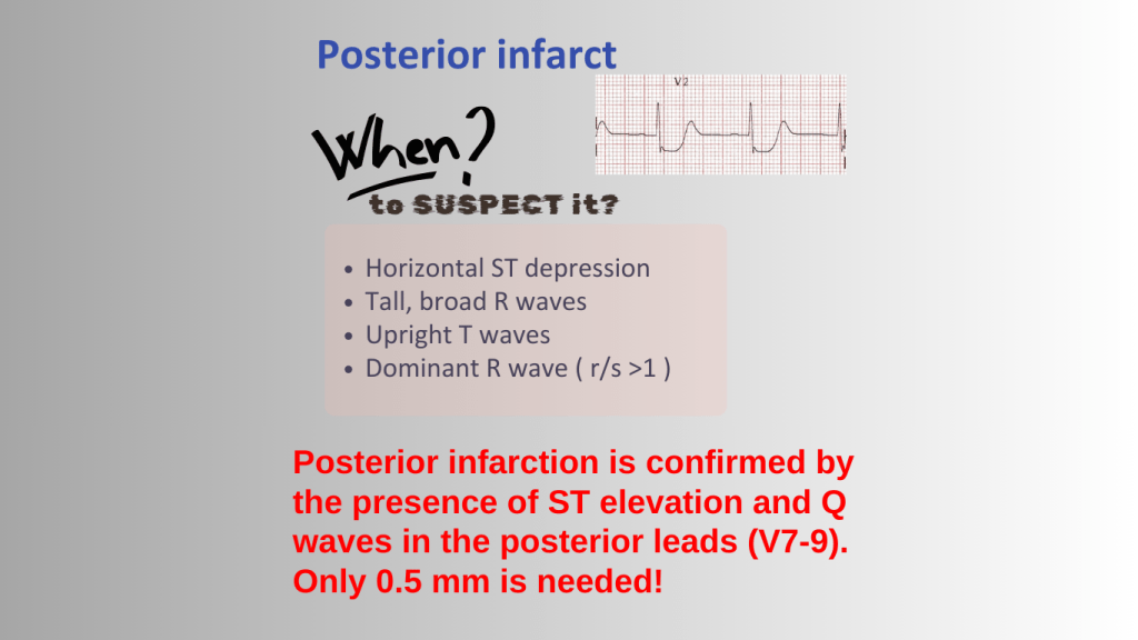 Educational slide on posterior myocardial infarction diagnosis, detailing signs such as horizontal ST depression, tall broad R waves, upright T waves, and the dominant R wave. Includes an ECG image with V2 lead presentation.
