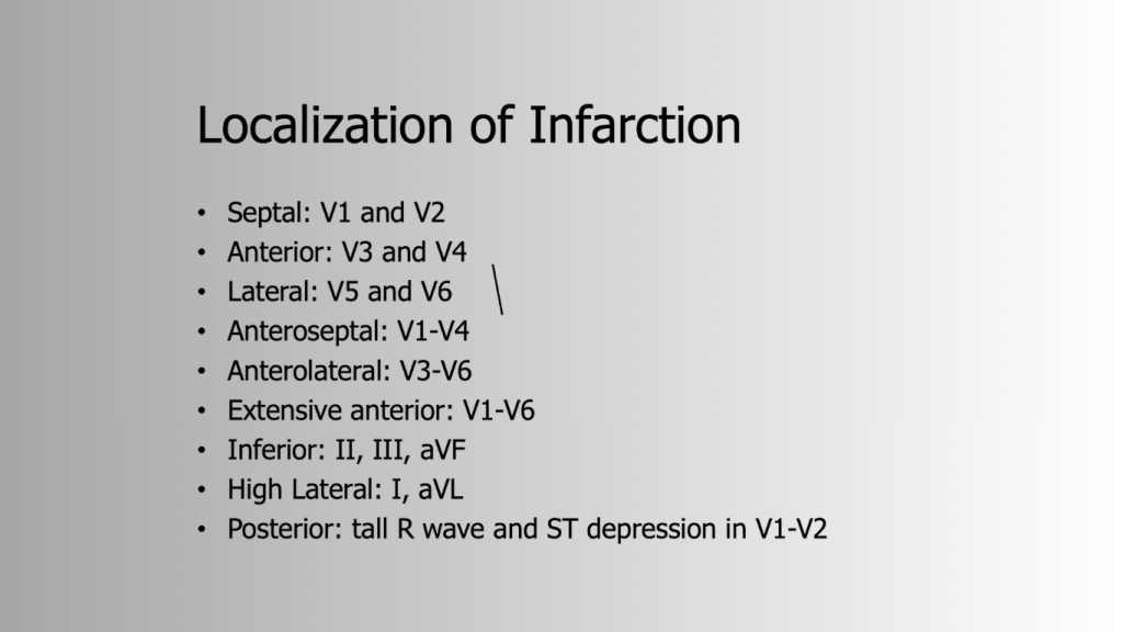 Slide detailing the localization of myocardial infarction indicating specific ECG leads for different types of infarction.
