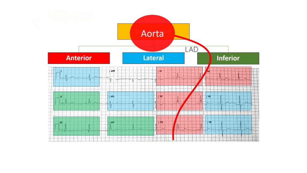 Diagram illustrating the relationship between the aorta and different myocardial regions, including anterior, lateral, and inferior sections, with associated ECG readings.