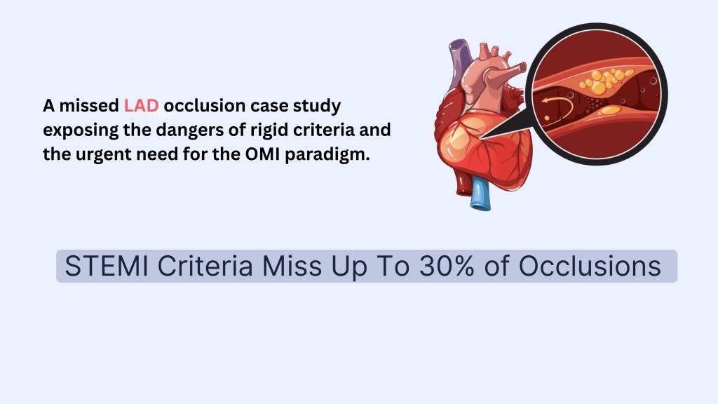 Illustration of a heart showcasing an LAD occlusion case study, emphasizing the risks of strict criteria and the need for the OMI paradigm. Text highlights 'STEMI Criteria Miss Up To 30% of Occlusions'.