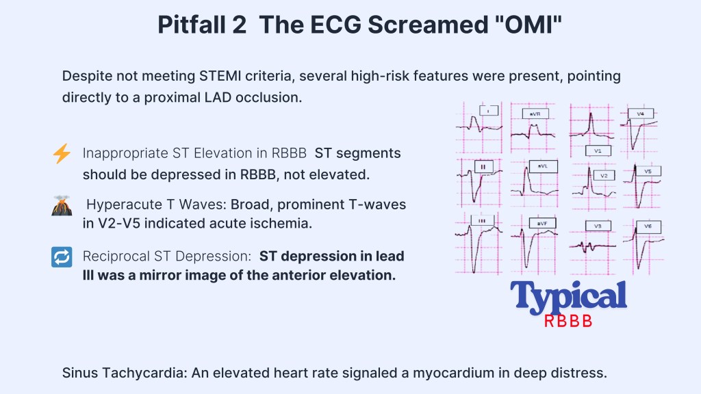 Infographic explaining ECG pitfall in determining proximal LAD occlusion with labeled ECG segments and annotations on inappropriate ST elevation, hyperacute T waves, and sinus tachycardia.