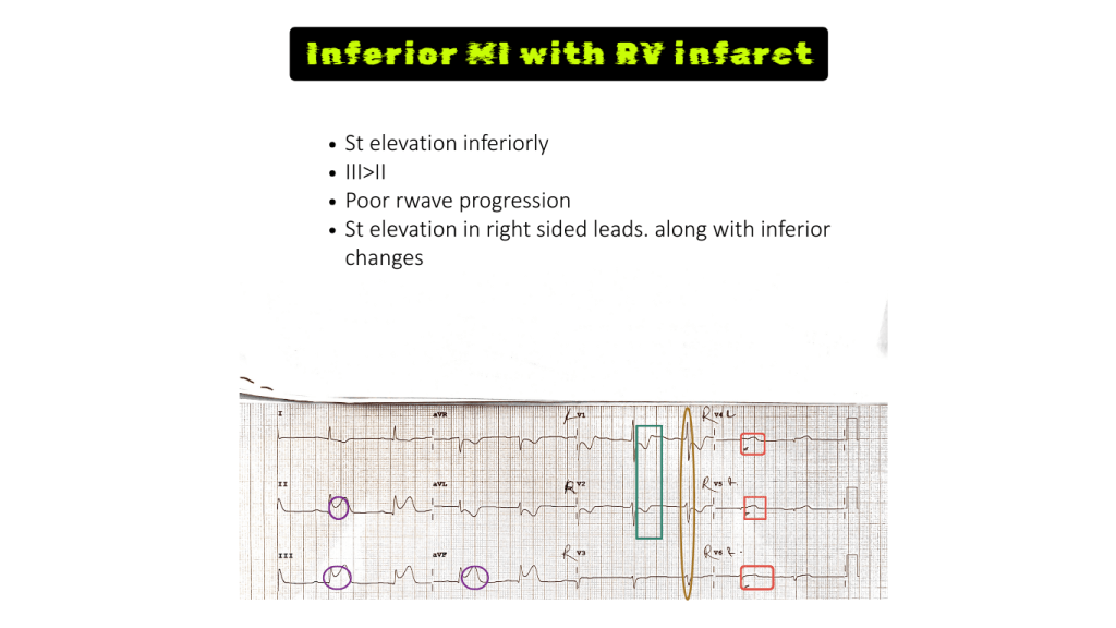 Electrocardiogram (ECG) showing inferior ST elevation and indications of right ventricular (RV) infarct, including lead comparisons and annotations.