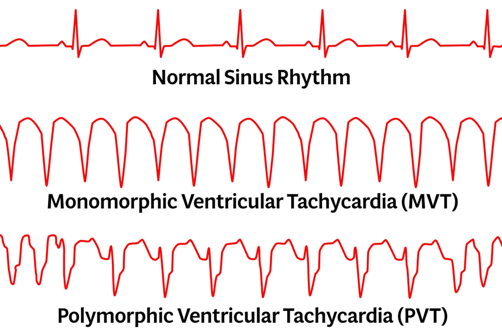 A graphical representation of three different heart rhythms: Normal Sinus Rhythm at the top, Monomorphic Ventricular Tachycardia (MVT) in the middle, and Polymorphic Ventricular Tachycardia (PVT) at the bottom, all shown in red.