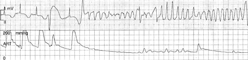 Graph depicting two sets of medical data: the top section illustrates an electrical activity waveform, while the bottom section shows arterial blood pressure readings marked in mmHg.