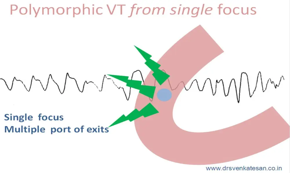Diagram illustrating polymorphic ventricular tachycardia (VT) originating from a single focus, showing a heartbeat waveform with labeled elements indicating single focus and multiple exit points.