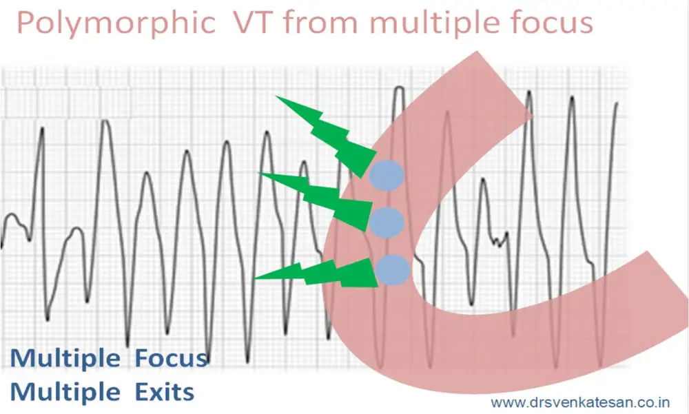 Diagram illustrating polymorphic ventricular tachycardia (VT) from multiple foci, featuring a stylized heart with multiple exit points and an ECG waveform in the background.