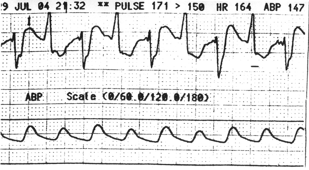 Medical chart displaying pulse, heart rate, and arterial blood pressure measurements over time, with noted values of pulse 171, heart rate 164, and ABP 147.